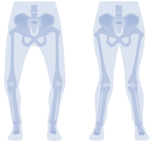 Informationsabend der Orthopädie: Beinfehlstellungen
